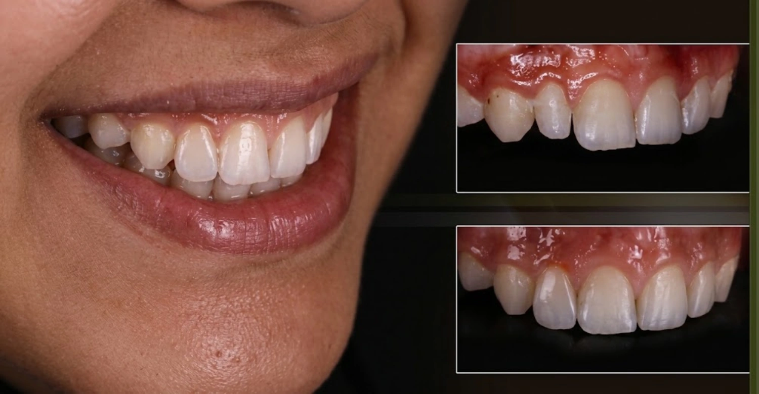 microdontia 2